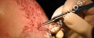 Graftok beültetése, implantáció Graftok beültetése, implantáció